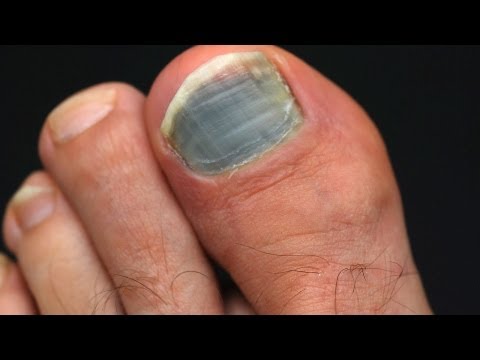 how to drain bruised toenail