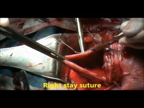 CESAREAN SECTION, step by step, by PROF. Dr. ARSHAD CHOHAN