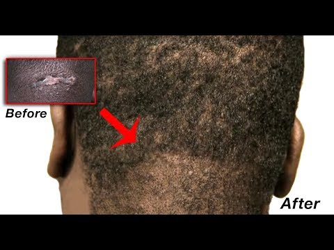 how to treat akn