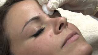 Blacketts Skin and Laser Clinic Botox treatment