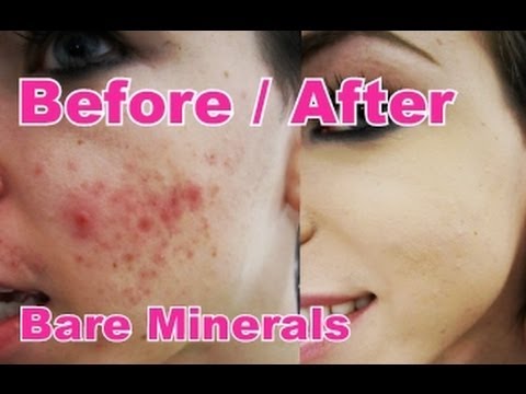 bare escentuals - My Foundation Routine using BareMinerals foundation for a perfect complexion. This is how I cover up my acne, scaring, redness and any other blemishes on my ...