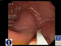 Colon Cancer