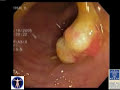 Colon Cancer