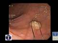 Colon Cancer