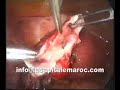 This video made by doctor Moulay nabil gynecologist in Morrocco (www.drmoulaynabil.com)shows a laparoscopic distal tubal repermeabilisaton.This endoscopic procedure are currently performed in clinique la capitale at Rabat Morrocco(www.lacapitalemaroc.com)