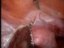 Single Port Access Surgery: LAVH