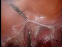 Single Port Access Surgery: LAVH