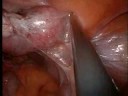 Single Port Access Surgery: LAVH