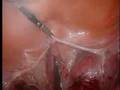 Single Incision Laparoscopic Surgery/ SILS/ SPA/ LESS: LAVH