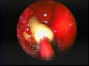 Endoscopic Drainage of an Orbital Mucocoele Endoscopic Drainage of an Orbital Mucocoele