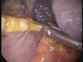 Laparoscopic Splenectomy