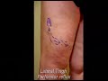 Vein Treatment with Dr. Khalil Fattahi Vein Treatment with Dr. Khalil Fattahi