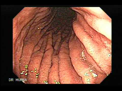 Endoscopy - This Video Clip showsa high resolution endoscopy displaying the stomach as well as the duodenum, the video clip also displays some sample of tissues obtains ...