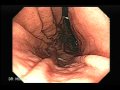 This Video Clip showsa high resolution endoscopy displaying the stomach as well as the duodenum, the video clip also displays some sample of tissues obtains by the forceps biopsy.