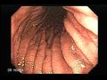 Endoscopy, Endoscopia