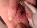 underarm infection 1
