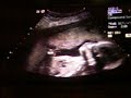 20w5d