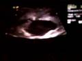 20w5d