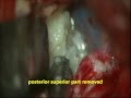 DERMOID right temporal lobe-microsurgical removal-dr suresh dugani / HUBLI / KARNATAK / INDIA