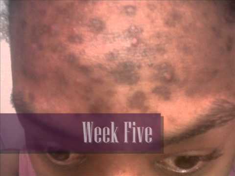Week Five Update - RX for Brown Skin and Royalty Spa (Skincare)