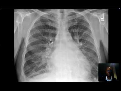 how to measure cardiomegaly on cxr