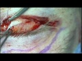 bit.ly Il chirurgo oculoplastico è quello pù indicato per eseguire tecniche di ricostruzione palpebrale che permettano la conservazione di una perfetta funzione palpebrale nel rispetto di un aspetto estetico risparmiato il più possibile.