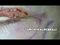 Tumori palpebrali: Asportazione Corretta Dr. F. Bernardini