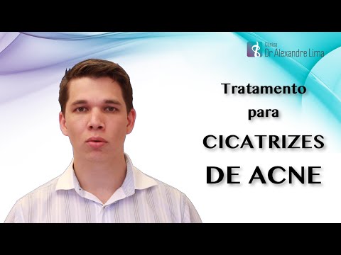 Cicatrizes de Acne - Tratamento com Laser de CO2 Fracionado