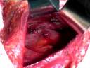 Mastectomia, impianto espansore, ricostruzione mammaria Mastectomia, impianto espansore, ricostruzione mammaria
