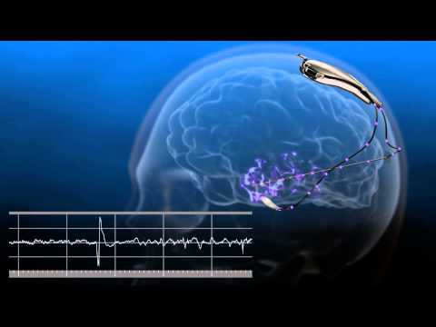FDA Grants Premarket Approval for the NeuroPace RNS System to Treat Epilepsy