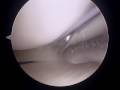 ZR Dr. Vangsness ACL surgery Part 10