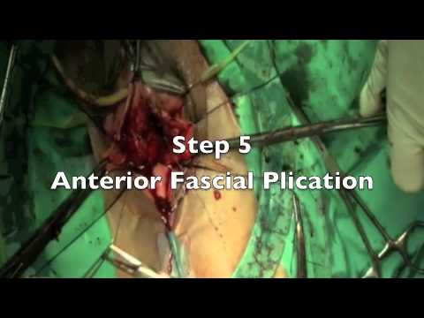 Vaginal Hysterectomy and Sacrospinous Fixation