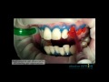 Doctor Smile Whitening Bleaching.flv