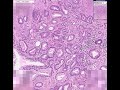 Histopathology Prostate --Adenocarcinoma (Gleason grade 2)
