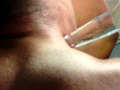 GIANT ZIT!!! hillbilly style!