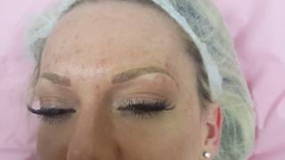 Microblading for Eyebrow Hairloss