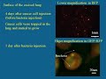 Tumor-Killing Bacteria - Part 2