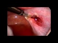The Jamhole - Danni's Laproscopic Ovarian Cyst / Tumor Surgery Part 2 of 4