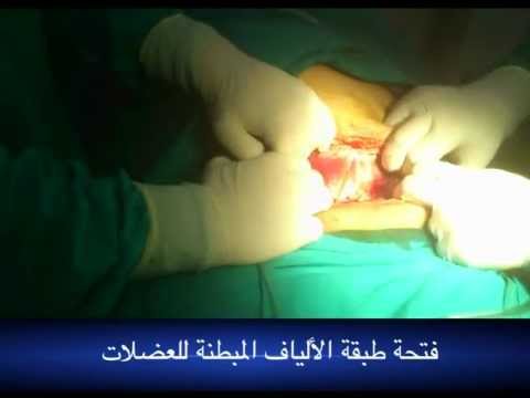 الولاده القيصريه كما لم تراها من قبل (د.وائل البنا)