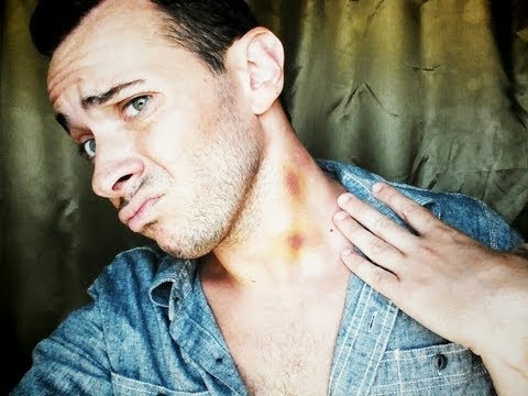 how to remove hickies