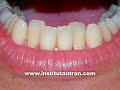 Est�tica dental: malposici�n inferior (problema y soluci�n)