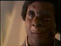 Neurofibromatosis - Reggie Bibbs Lives with Disease