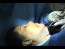 The UpLift Facelift - Part II Naples Florida