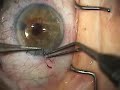Ant. Vitrectomy & Secondary A/C IOL, Pt. 3 of 3