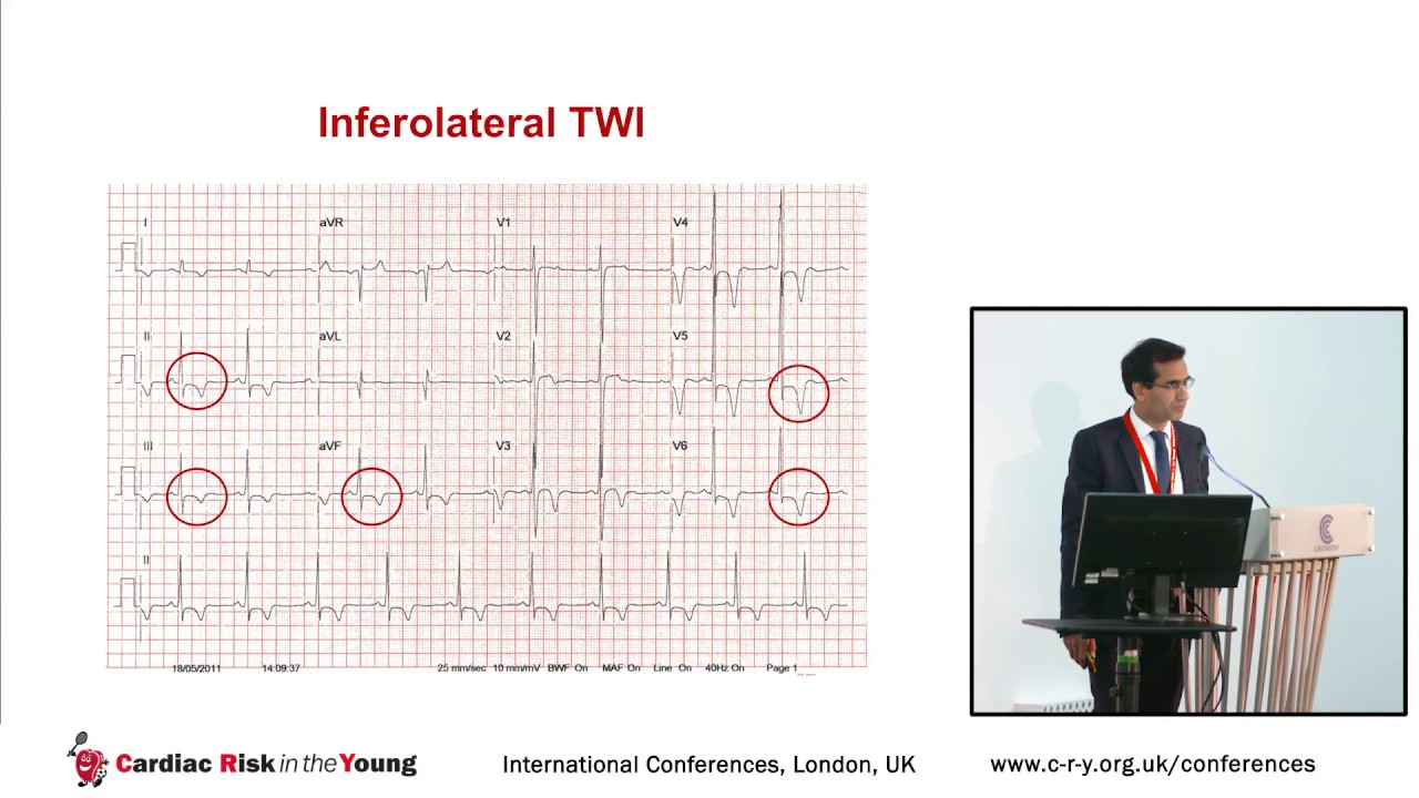ECG indices of cardiomyopathy - Dr Nabeel Sheikh