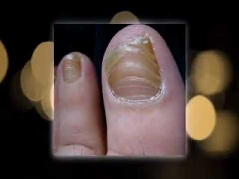 how to get rid yellow toenails
