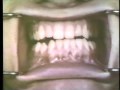 Open Bite Surgical Procedures – Ostectomy for Prognathism