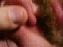 Blackheads part 1