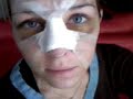 RINOPLASTIA EXITOSA!!!!!!!!!!!!!!!!!