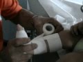 videos de bendaggi funzionali per piede torto